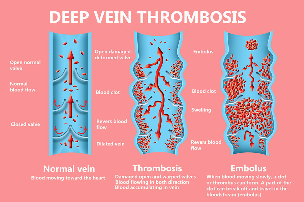 La thrombose est la formation d\'un caillot sanguin dans un vaisseau sanguin. 